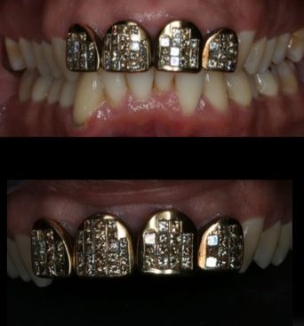 Before a smile makeover.