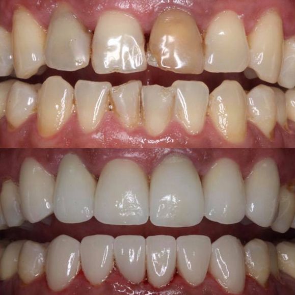 Before and after porcelain veneers treatment.