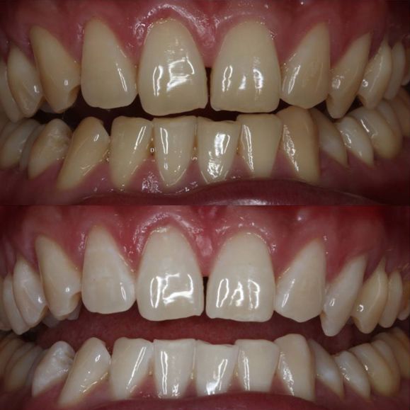 Before and after teeth whitening treatment.