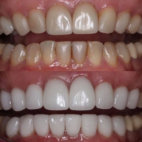 Before and after smile makeover treatment.